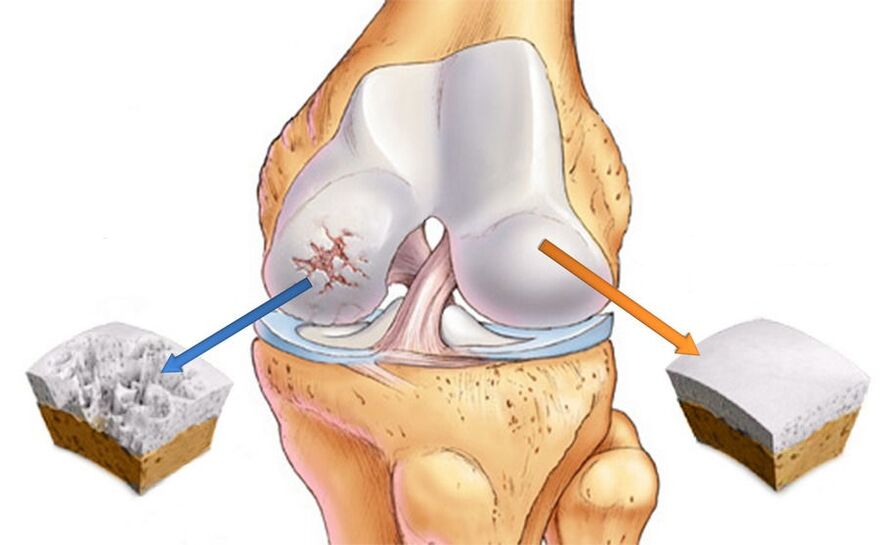 Arthrosis vum Kniegelenk a gesonde Knorpel