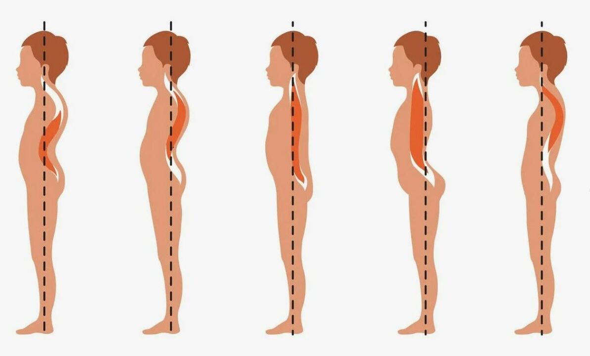 Grad vun der Entwécklung vun der Lendeger Osteochondrose