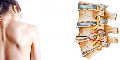 De Mechanismus vun der Entwécklung vu Gebärmutterhals Osteochendrosis