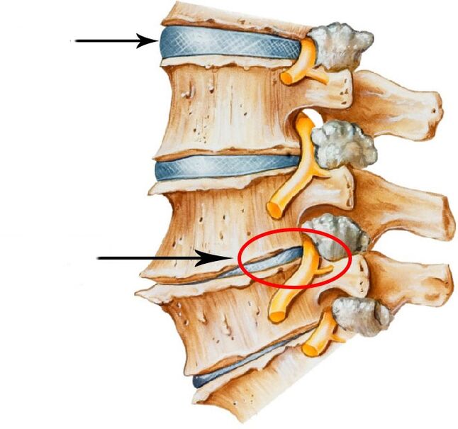 Entwécklung vun Disk Hernia