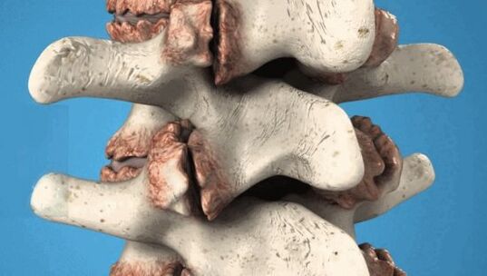 Osteophyte vun der Wirbelen - pathologesch Wuesstum déi Nerven an Bluttgefässer schueden