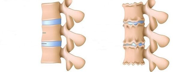 Gesond Pick an Osteochondrosis