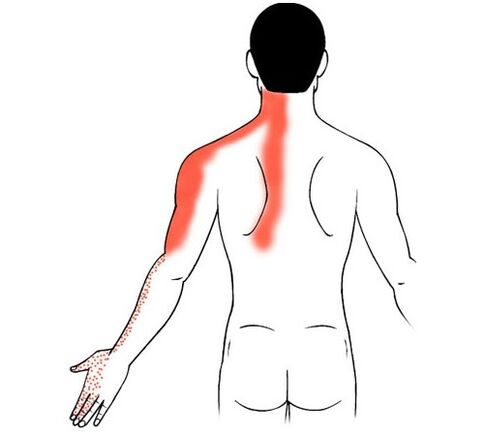cervical osteochondrosis als Ursaach vun Péng an de Gelenker vun de Fanger