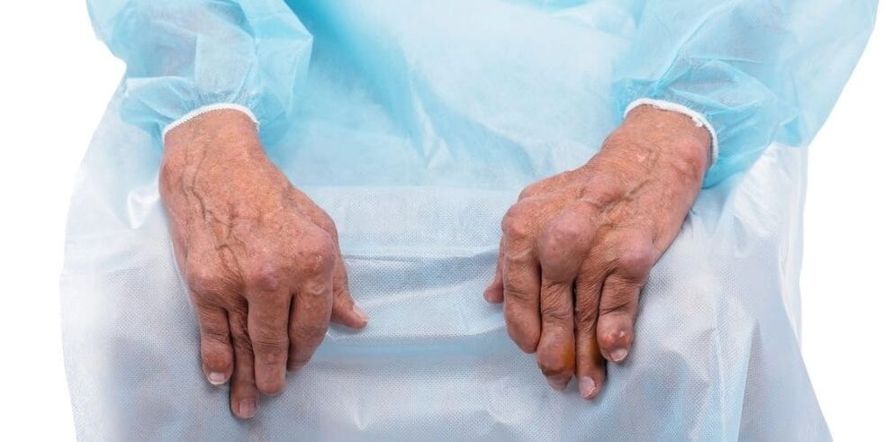 Infektiiv Arthritis ass eng Krankheet mat konstante Schmerz a Verännerungen an de Gelenker vun de Fanger.