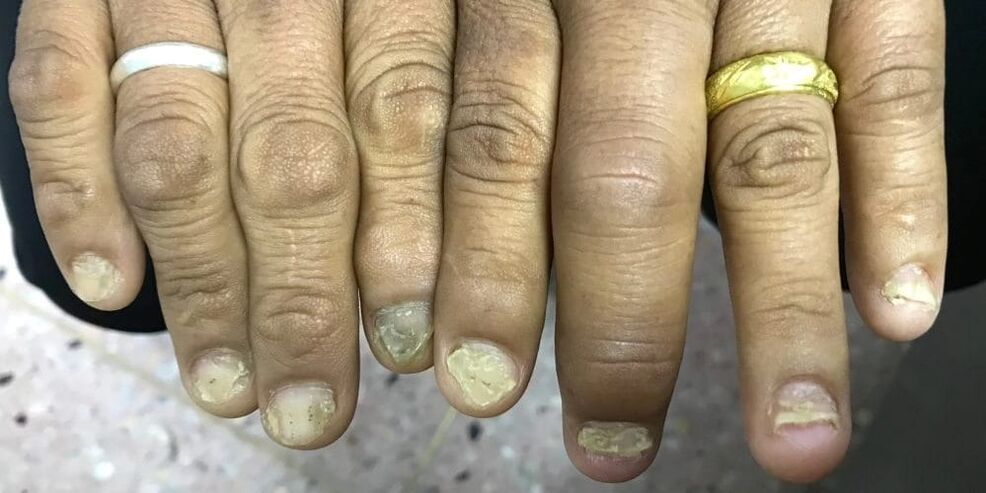 Schwellung vun de Fanger an Deformatioun vun der Nagelplack kënnen d'Entwécklung vun der psoriasescher Arthritis uginn
