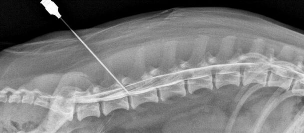 Blockade vun der Wirbelsäule mat Osteochondrose