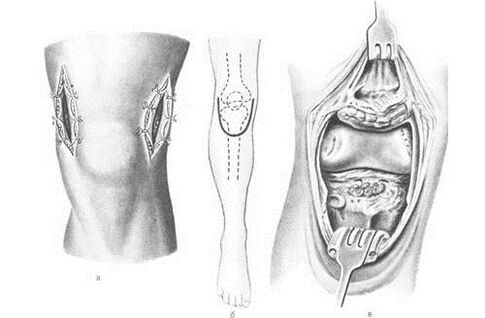 Arthrotomie Chirurgie fir Arthrosis