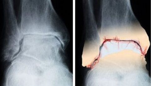 gesond an arthrotic Gelenker